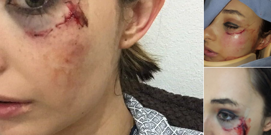 Atriz Elisa Vicedo teve o rosto golpeado pelo ator Eduardo Carbajal (Divulgação: Tv Y Novelas)
