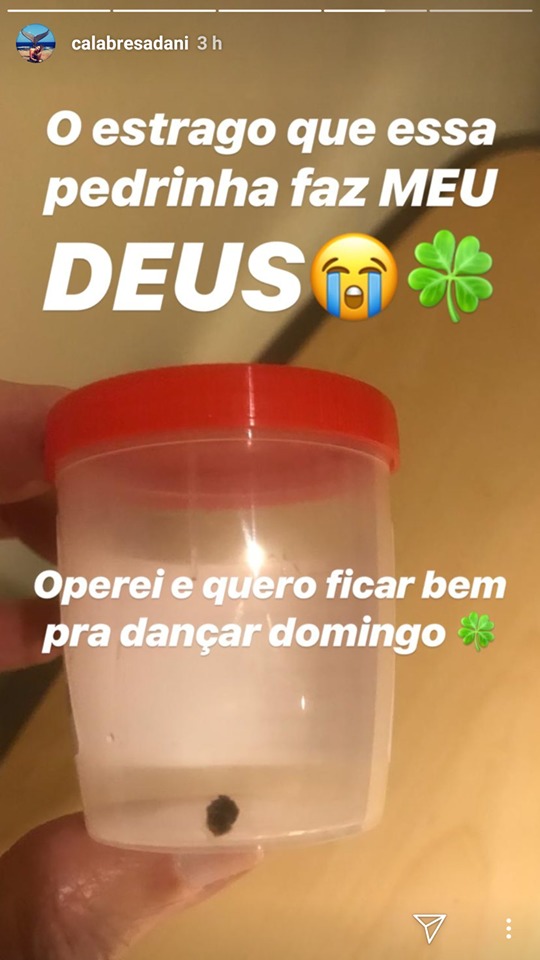 Dani Calabresa mostrou a pedra que tirou do rim