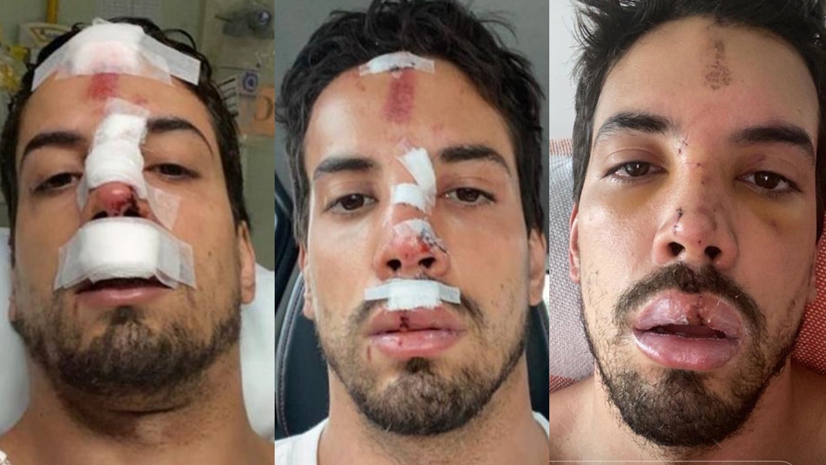 Felipe de Carolis revela grave acidente que sofreu durante a pandemia (Reprodução: Instagram)
