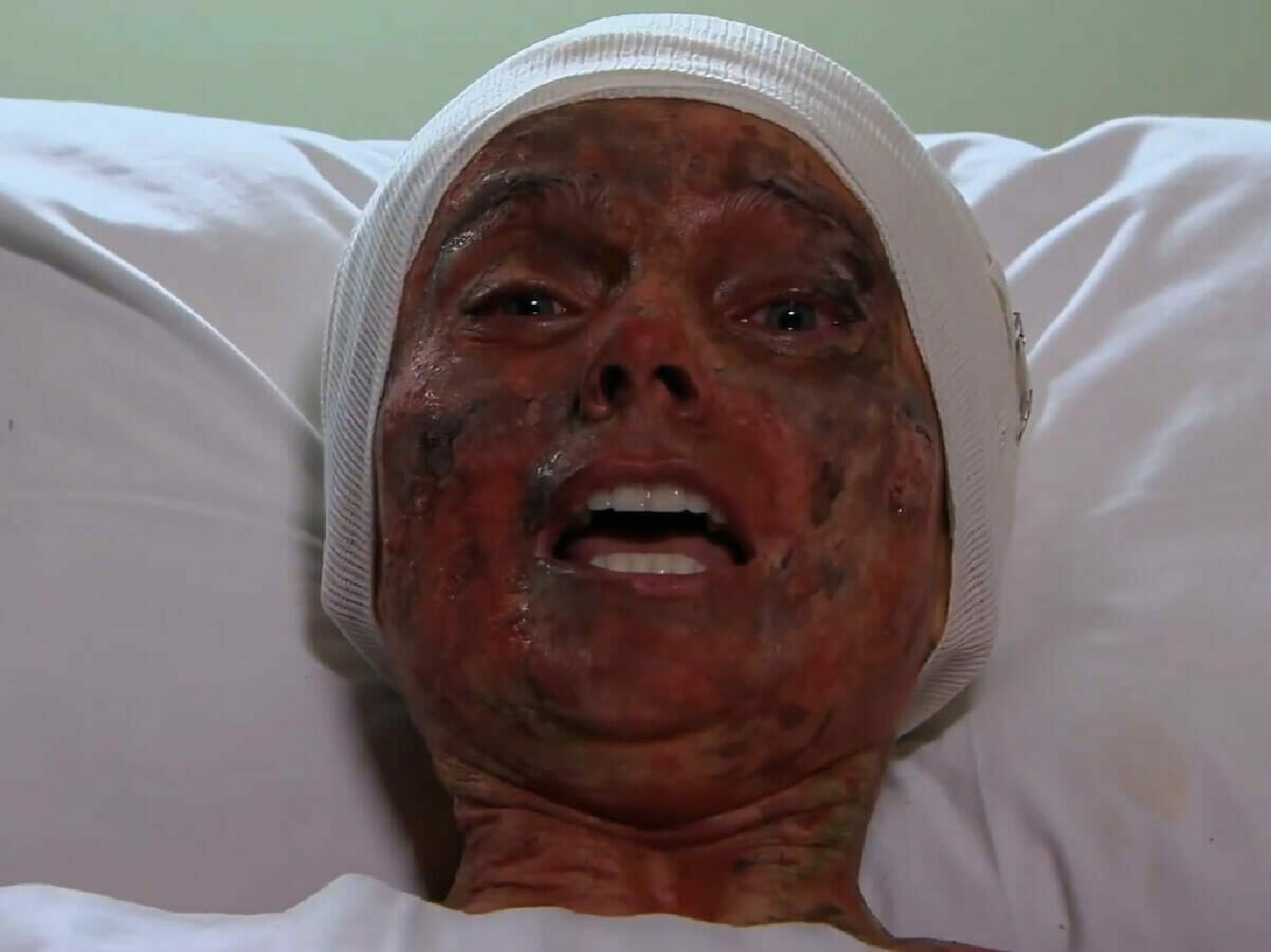 Acidente deixa Lúcia (Elizabeth Álvarez) carbonizada em Coração Indomável (Reprodução/SBT)